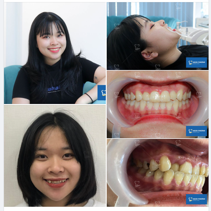 Niềng răng có thể đẹp đến cỡ nào?
