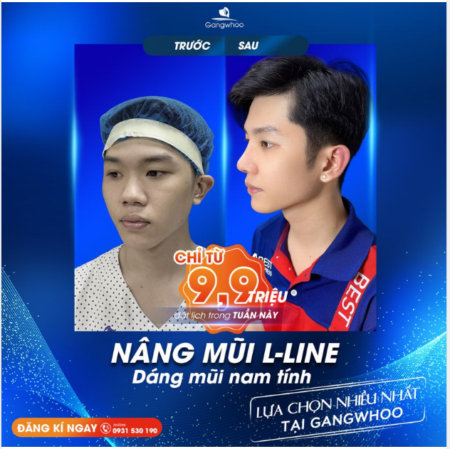 NÂNG MŨI NAM - MŨI CAO ĐÃ GIÚP BẠN ĐẸP HƠN 90%