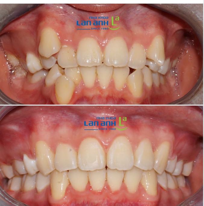 Một ca niềng bằng mắc cài tự buộc Damon Q của chi nhánh Phú Nhuận, bác sĩ Hà điều trị!