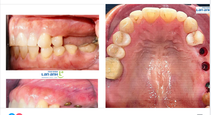 Hình ảnh 1 case đặt Implant MIS C1- Đức vị trí răng 25, 26, 27 do Bác sĩ Nam- chi nhánh 292 Huỳnh Văn Bánh thực hiện.
