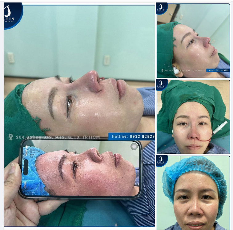"Chỉ đợi Latin khai xuân để đi sửa mũi"