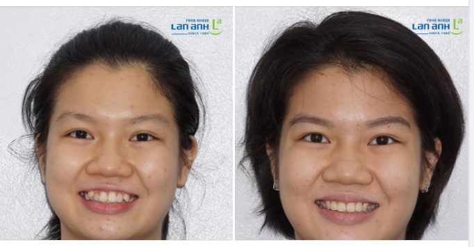 Niềng răng ở lứa tuổi nào để kết quả tốt và chính xác?