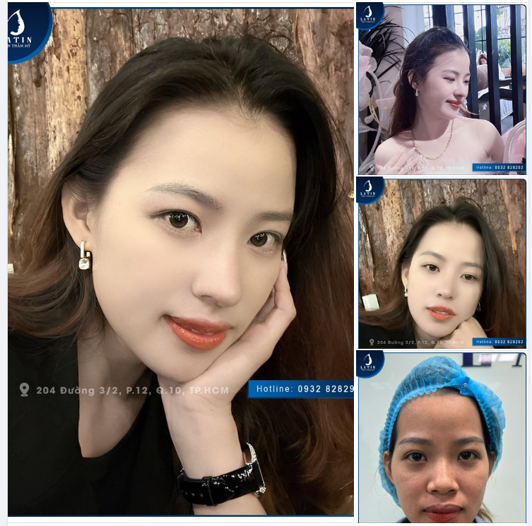 Feedback: Sở hữu nét đẹp rạng ngời chỉ sau 3 tuần nâng mũi tại Latin