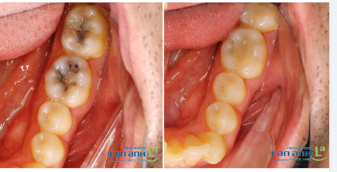Một ca trám răng bằng vật liệu Composite của BS Liên chi nhánh Sala