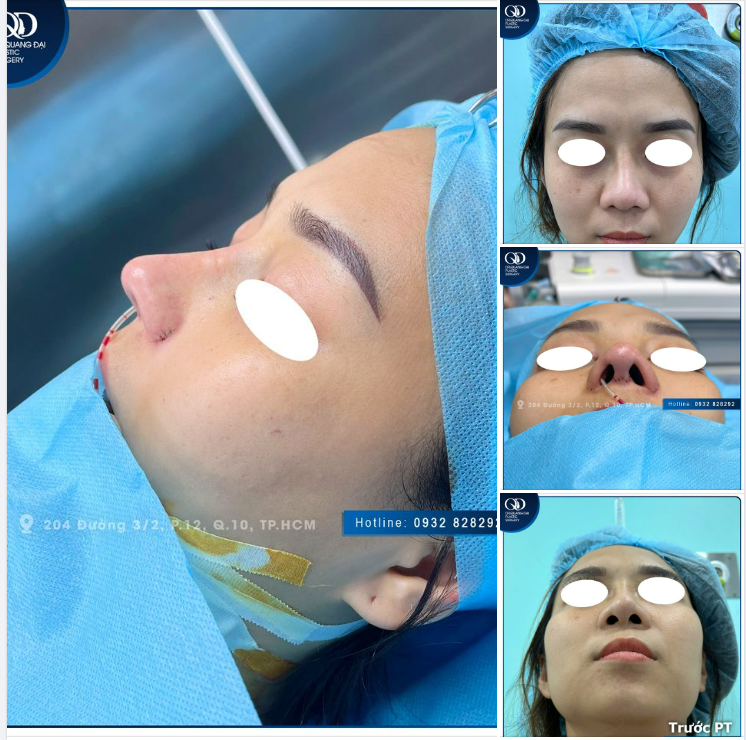 Khắc phục tình trạng mũi đã nâng bị lệch, lộ sóng với phương pháp cấu trúc sụn tai