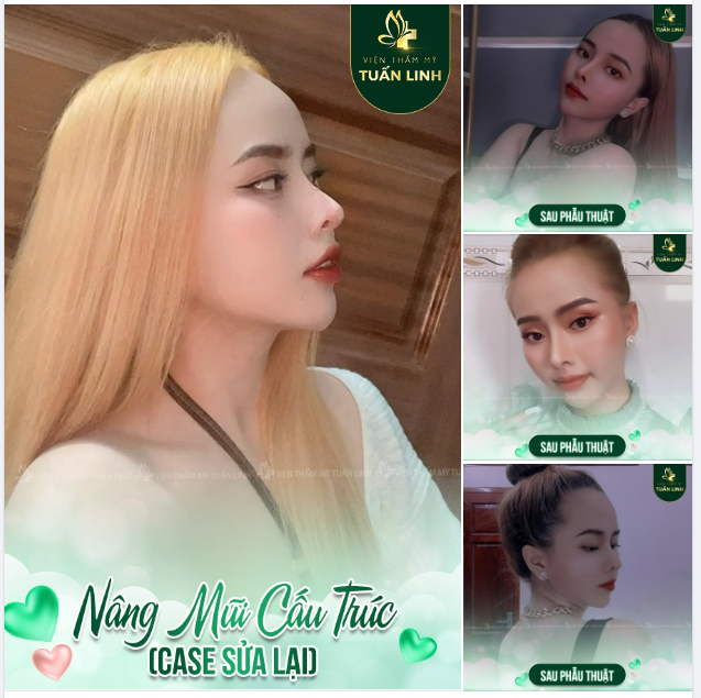 NÂNG MŨI CẤU TRÚC SỬA LẠI - BỀN - ĐẸP - AN TOÀN!!
