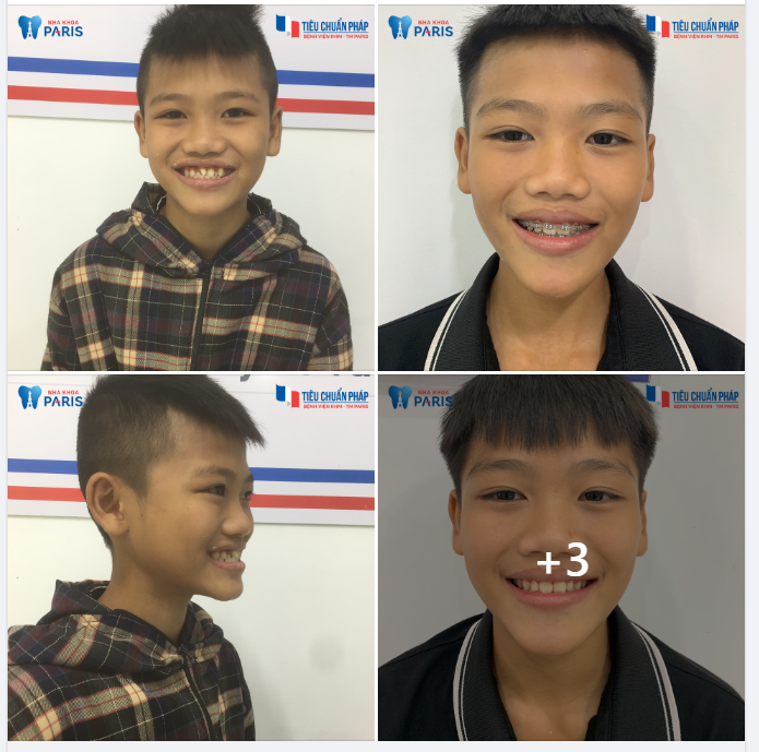 Niềng Răng Cho Con