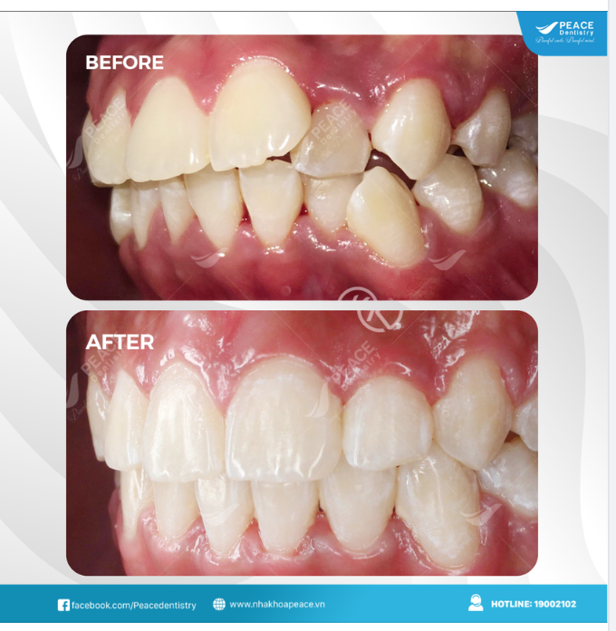 Ca lâm sàng niềng răng khấp khểnh - thời gian hoàn thành 18 tháng