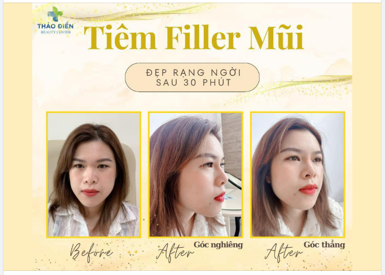 TẠO HÌNH MŨI BẰNG FILLER