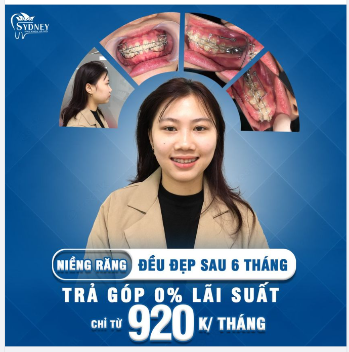 Có nên niềng răng không? Những lợi ích mà niềng răng mang lại
