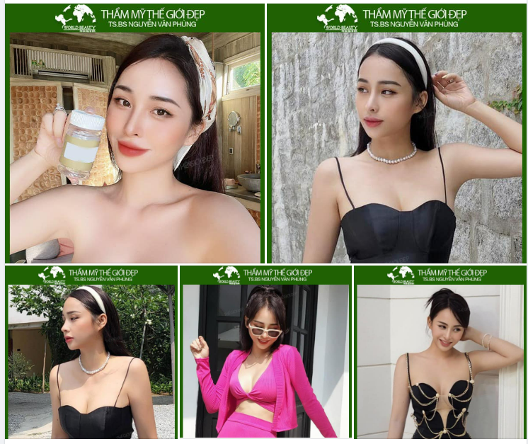 Nâng cấp vòng 1 Mẹ bỉm sữa sau sinh thêm một lần gia hạn thanh xuân cho vóc dáng