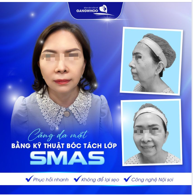 CĂNG DA MẶT BẰNG KỸ THUẬT BÓC TÁCH LỚP SMAS