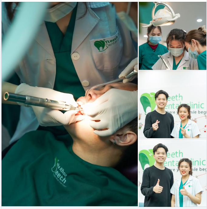 Lựa chọn cắt lợi sau khi niềng răng.