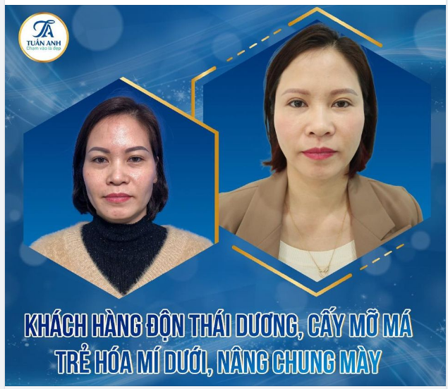 Lấy lại diện mạo trẻ trung, đường nét gương mặt cân đối với Combo dịch vụ