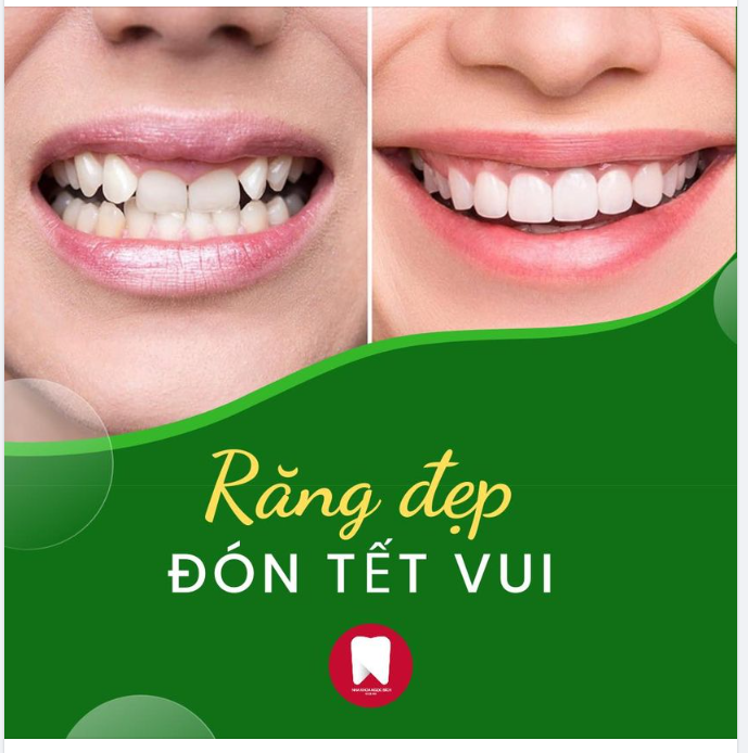 Răng nhiễm màu nặng, hình thể xấu