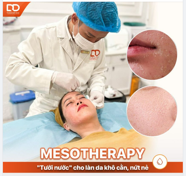 Mesotherapy - "Tưới nước" cho làn da khô cằn, nứt nẻ.