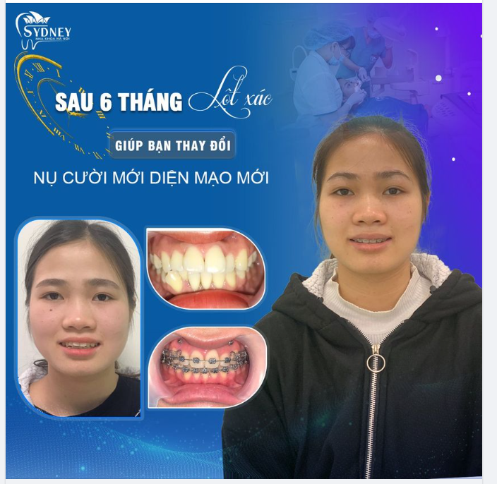 Niềng răng thay đổi nụ cười – Tại sao không?