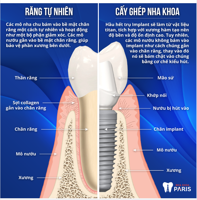 Răng thật và răng Implant khác nhau như thế nào?