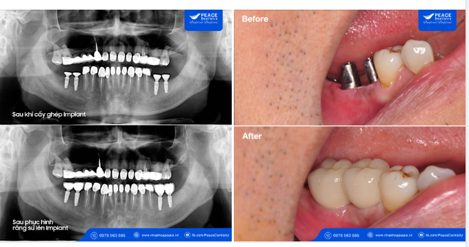  Cấy ghép trụ Implant sau bao lâu mới có thể cố định răng sứ hoàn thiện?