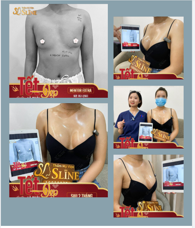 FEEDBACK KHÁCH HÀNG NÂNG NGỰC