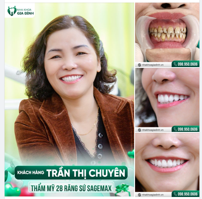 MẤT ĂN, MẤT NGỦ VÌ RĂNG KHIẾM KHUYẾT