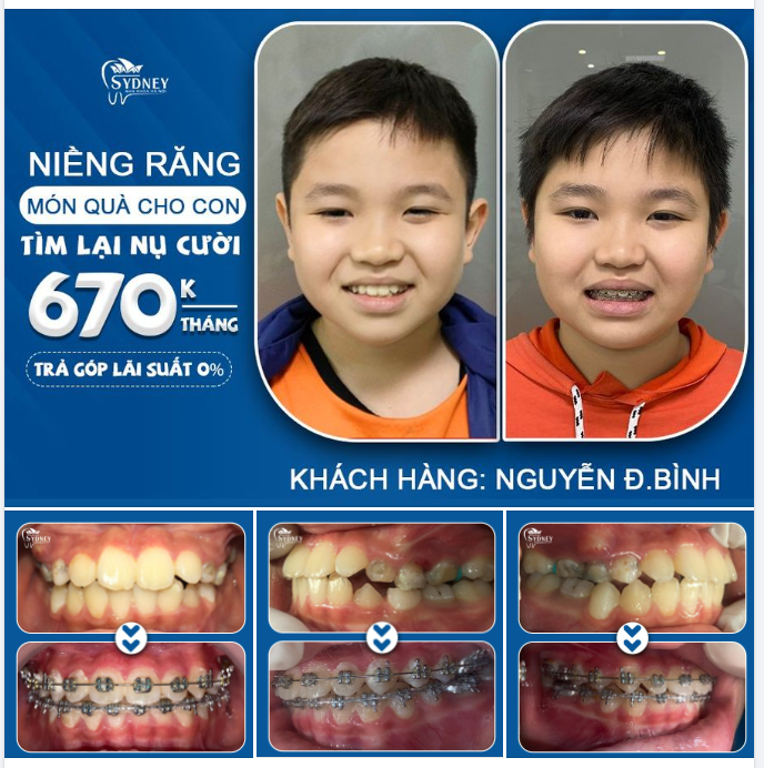Niềng răng – Đầu tư cho con không bao giờ là phí