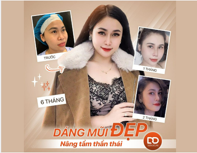 NÂNG MŨI XONG THẦN THÁI KHÁC NGAY