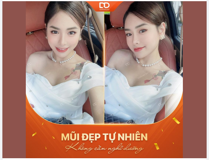 MUỐN NÂNG MŨI NHƯNG NGẠI NGHỈ DƯỠNG