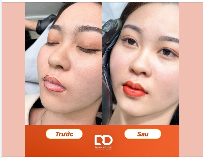 Phun môi collagen - Đẹp ngay lập tức!