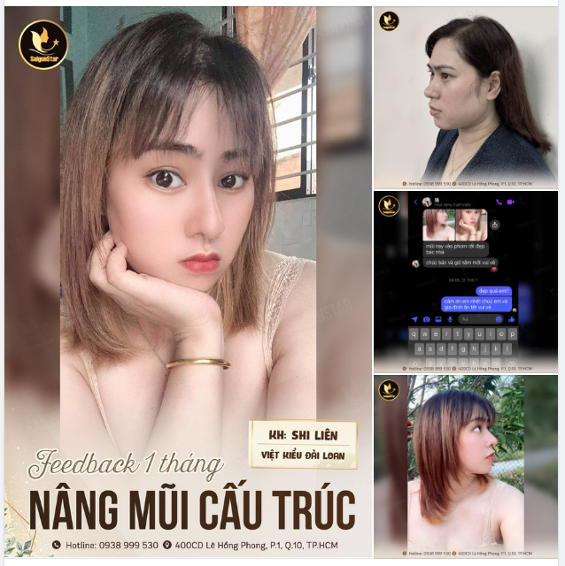 FEEDBACK 1 THÁNG NÂNG MŨI CẤU TRÚC