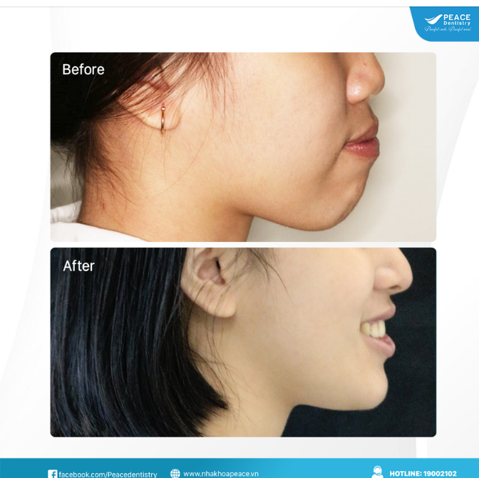 DẬY THÌ THÀNH CÔNG NHỜ THAY ĐỔI KHUÔN MẶT SAU KHI NIỀNG RĂNG