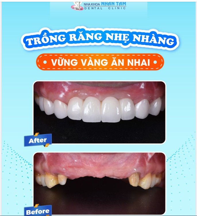 "Tôi chưa bao giờ nghĩ khi làm răng xong mình sẽ thay đổi nhiều đến thế!" Đó là những lời chia sẻ vỡ òa hạnh phúc của cô B.T.D trong ngày tái khám đầu năm.