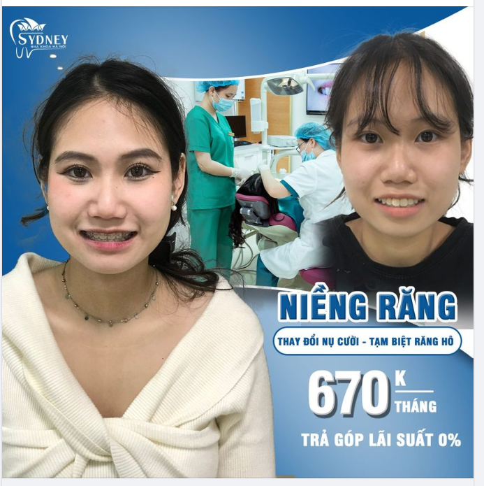 Niềng răng hô mất bao lâu?