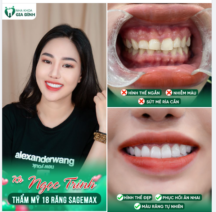 HÀM RĂNG ĐẸP CHÍNH LÀ MÓN QUÀ Ý NGHĨA MÀ NỮ KHÁCH HÀNG TỰ TẶNG BẢN THÂN NHÂN NGÀY SINH NHẬT