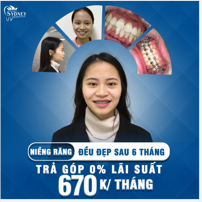 Đâu là địa chỉ niềng răng mắc cài kim loại uy tín, chất lượng?