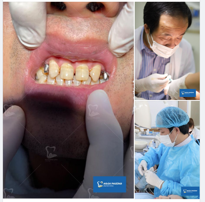 Nghe xong 2 bài hát là hoàn thành ca cắm trụ implant rồi
