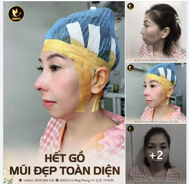 HẾT GỒ - MŨI ĐẸP TOÀN DIỆN ĐÓN 2023