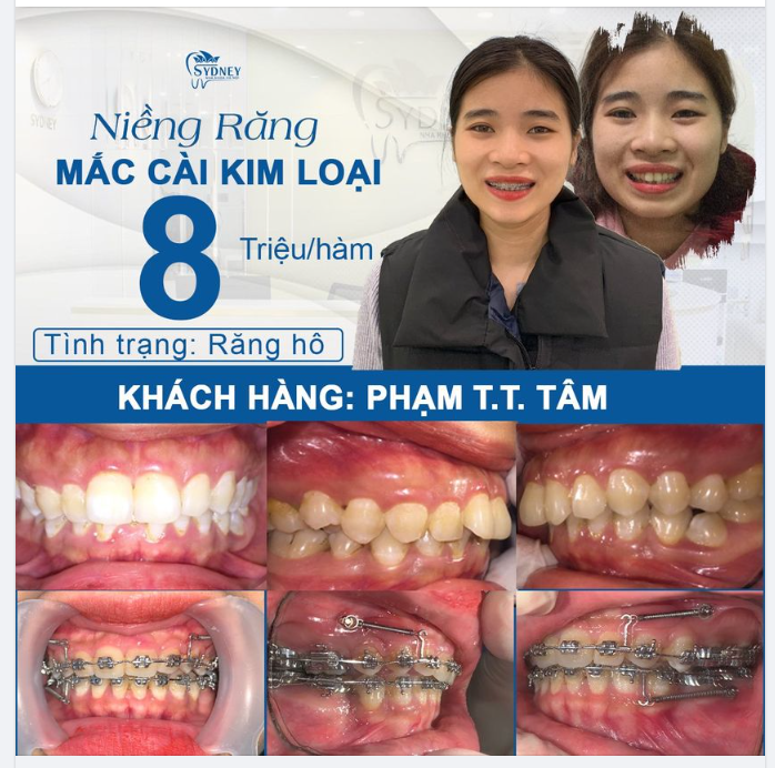 Răng hô có khắc phục được không?