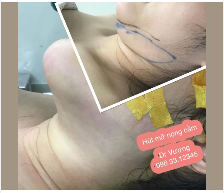 Đánh bay nọng cằm, nhẹ nhàng đón tết với Dr Vương >>> ảnh cằm trước  sau vừa hút mỡ !