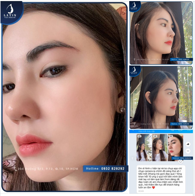 Feedback Combo MŨI - CUNG MÀY - MÍ DƯỚI sau 2 tháng