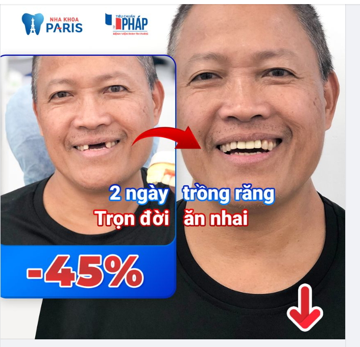 KẾT QUẢ CẤY GHÉP IMPLANT CỦA CHÚ MAI - 60 TUỔI