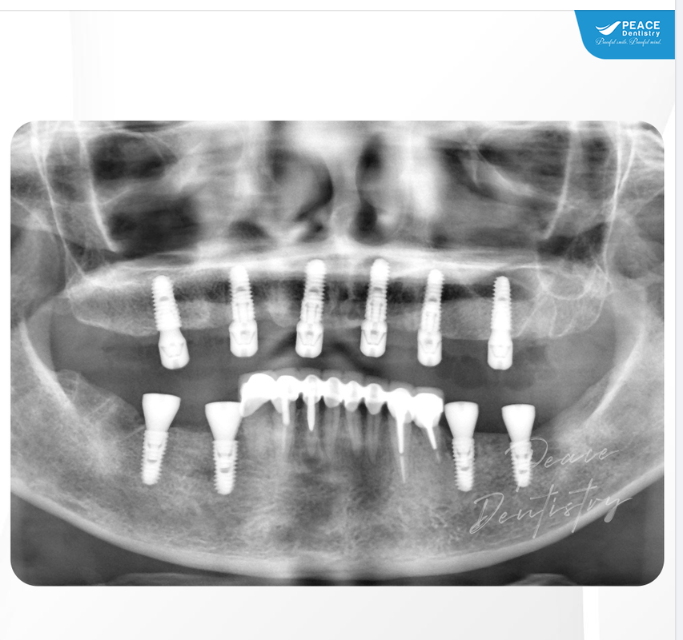 Hoàn thành ca cấy ghép All-on-6 Implant hàm trên và 4 đơn vị Implant hàm dưới (Implant Hiossen - made in USA) cho Cô khách hàng 56 tuổi tại Peace Dentistry.