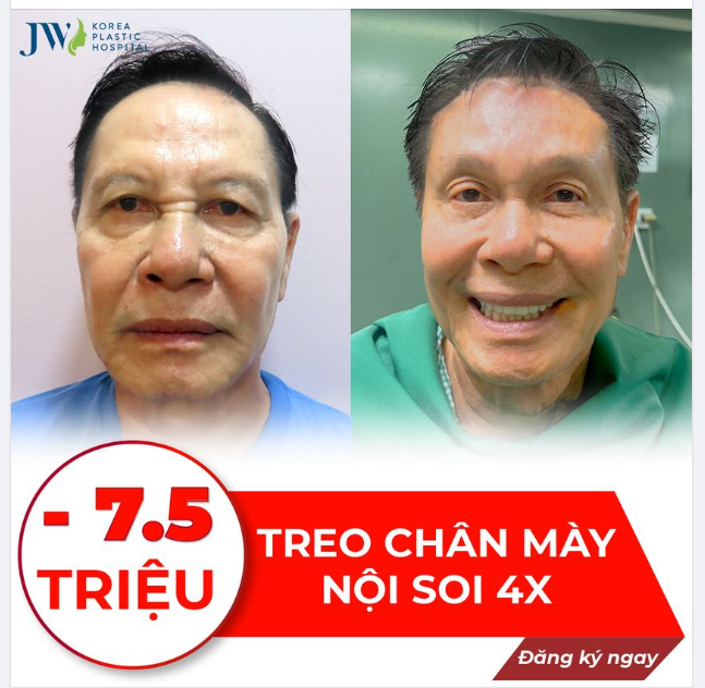 LẤY LẠI VẺ ĐẸP ĐÔI MẮT VỚI CÔNG NGHỆ TREO CHÂN MÀY NỘI SOI 4X