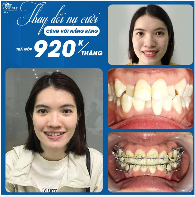 Ưu điểm của niềng răng mắc cài trong suốt