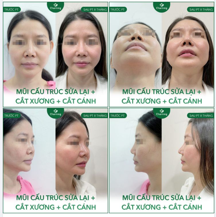 Mũi trước đó tuy có sửa qua nhưng sóng mũi lệch hẳn, khiến sóng mũi một nơi, chóp mũi một nẻo.