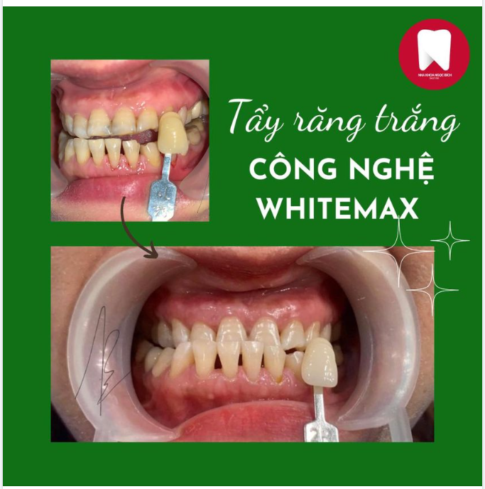 TẨY TRẮNG RĂNG WHITEMAX - TIẾT KIỆM, NHANH CHÓNG, RĂNG SÁNG BẬT TONE