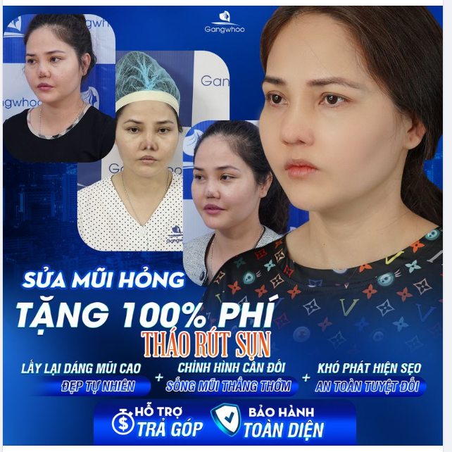 NHỮNG LƯU Ý TRƯỚC KHI SỬA LẠI MŨI HỎNG SAU NÂNG