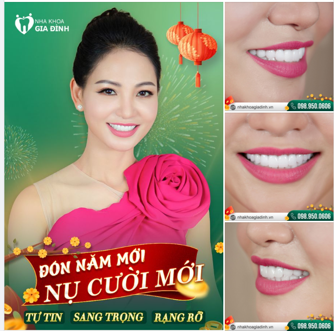 RĂNG ĐẸP ĐÓN TẾT – NĂM MỚI VẠN ĐIỀU MAY
