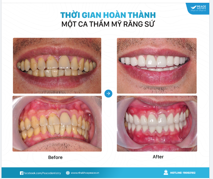 THỜI GIAN HOÀN THÀNH MỘT CA THẨM MỸ RĂNG SỨ LÀ BAO LÂU?