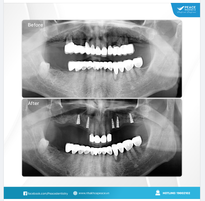 CA LÂM SÀNG THAY 2 CẦU RĂNG SỨ ĐÃ XUỐNG CẤP BẰNG IMPLANT BỀN VỮNG